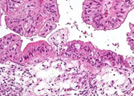 【Science速递】“沉默的杀手”卵巢癌的治疗新靶点终于被发现了